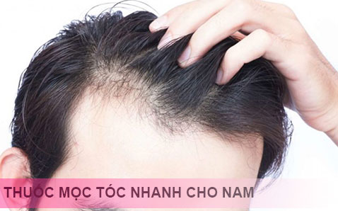 Top 5 loại thuốc mọc tóc tốt nhất hiện nay dành cho người hói đầu